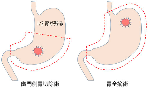 手術の方法（胃がん）