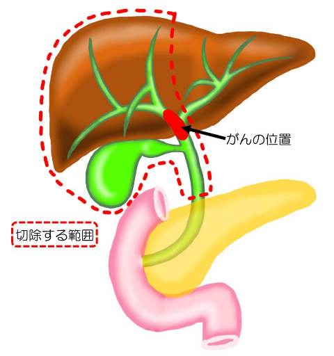 肝門部領域胆管がんの術式